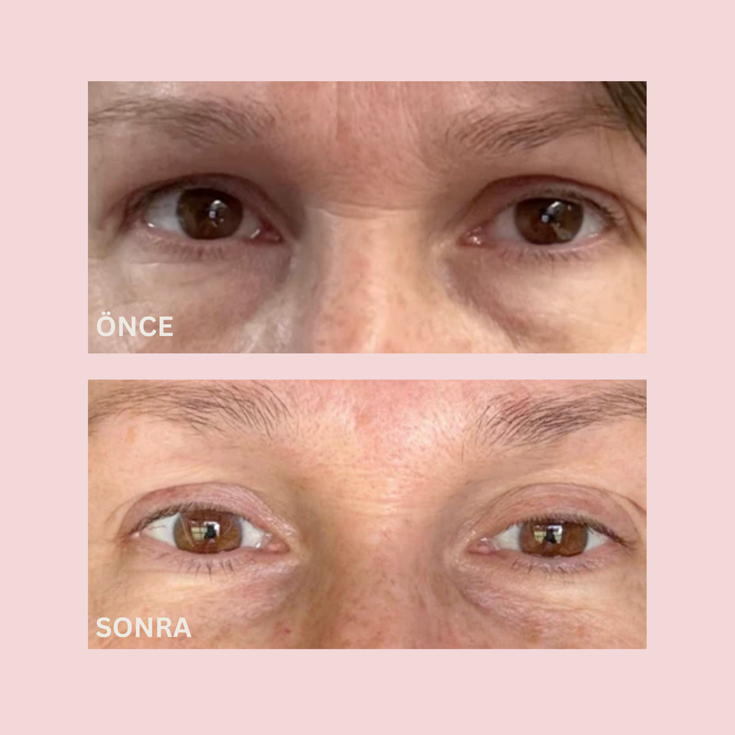 Instant Lift PDRN Göz Çevresi Maskesi®