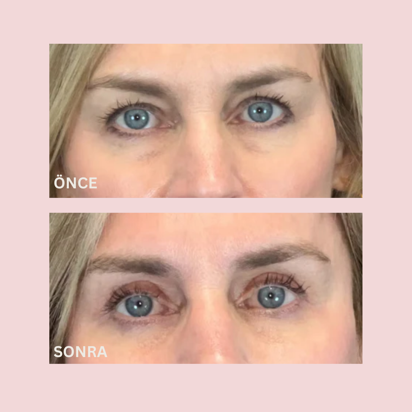 Instant Lift PDRN Gözaltı Maskesi®