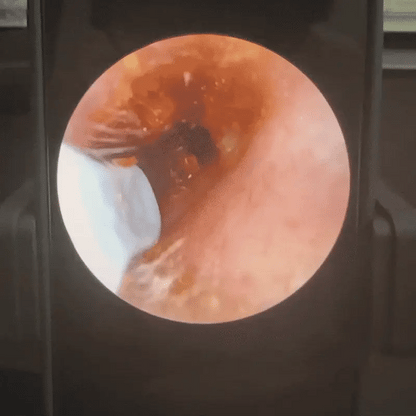 Luna Ear® - Kameralı Kulakiçi Temizleyici