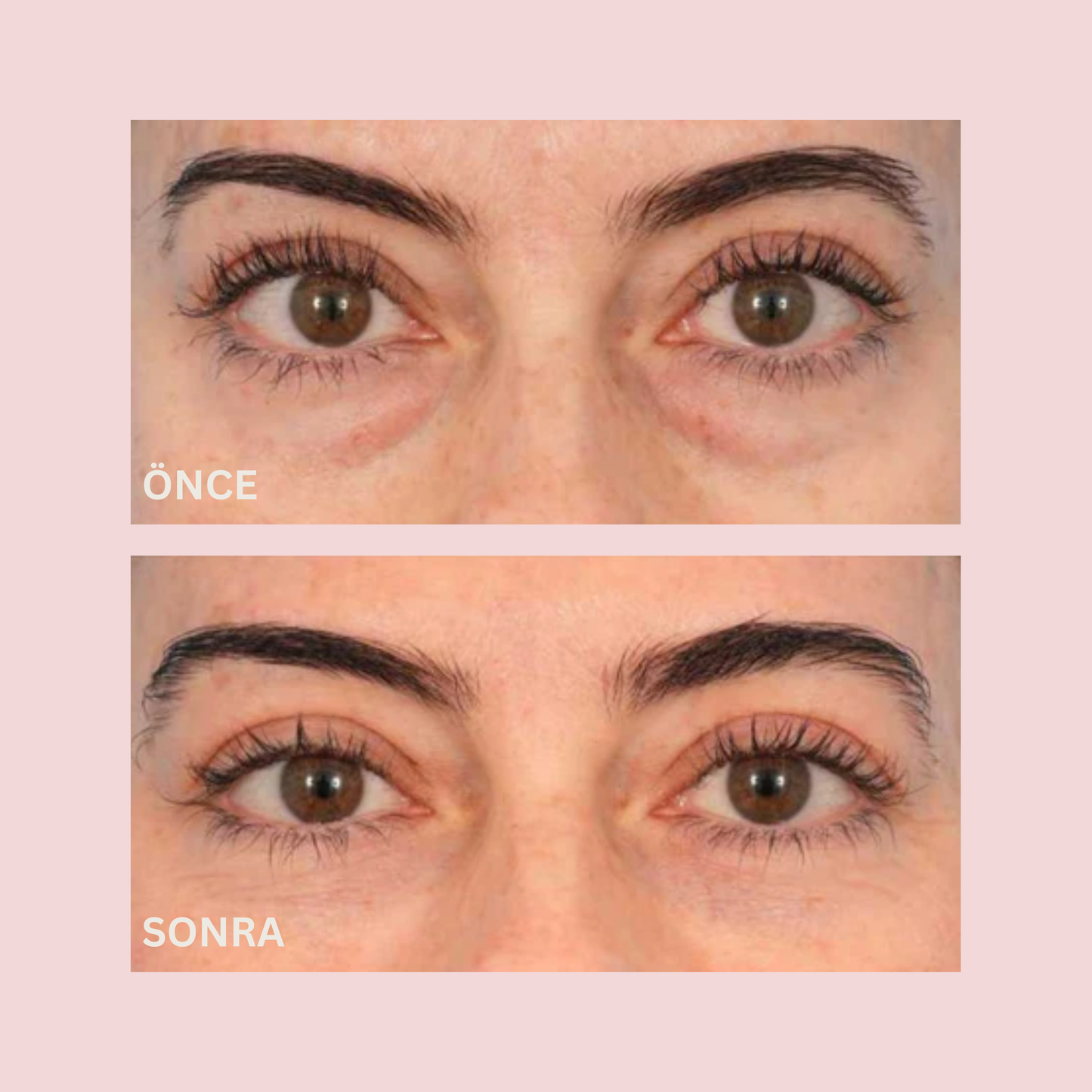 Instant Lift PDRN Gözaltı Maskesi®